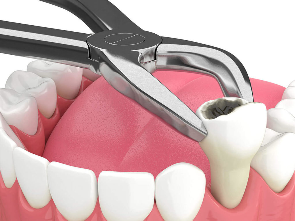 illustration mock up of tooth extraction