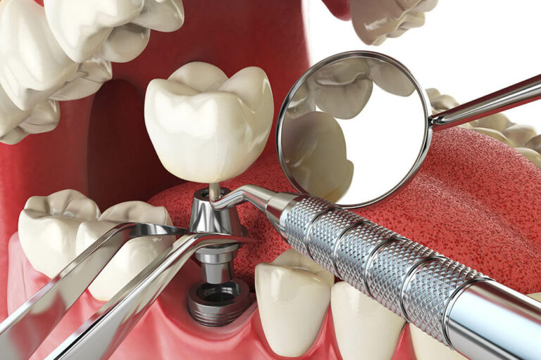visual mock up of a dental implant being placed on the bottom row