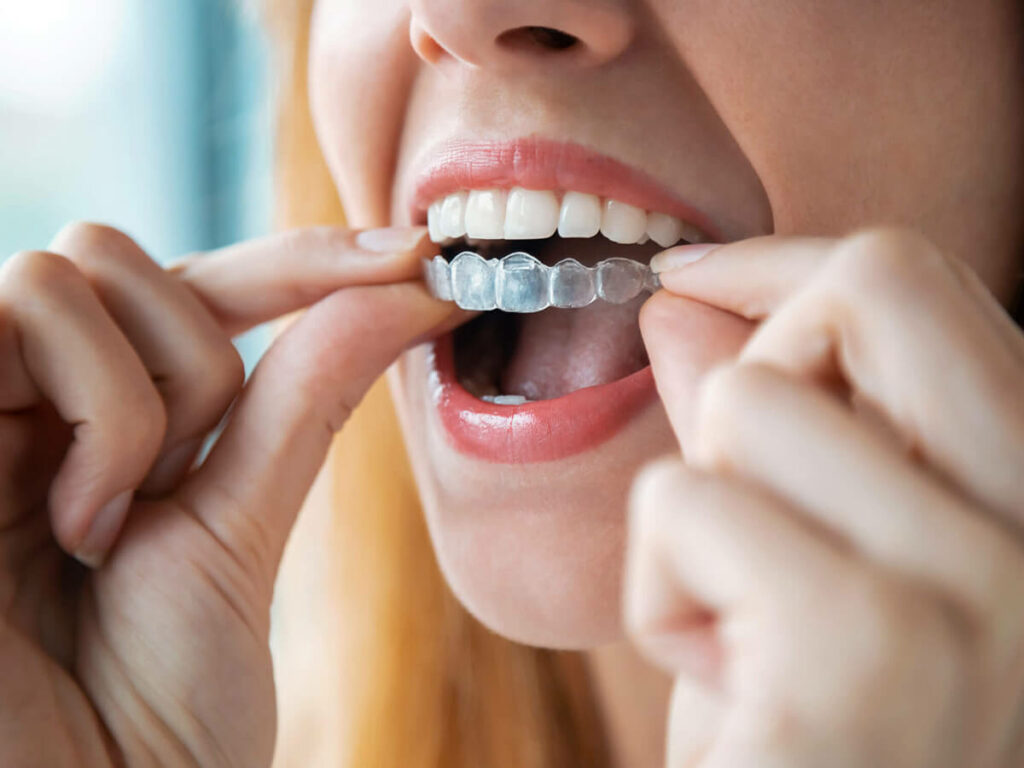 woman placing clear aligner on her upper row of teeth