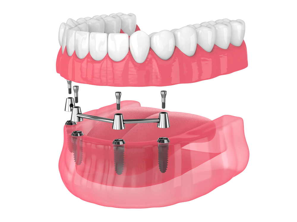 graphic mock up of all on 4 dental implants